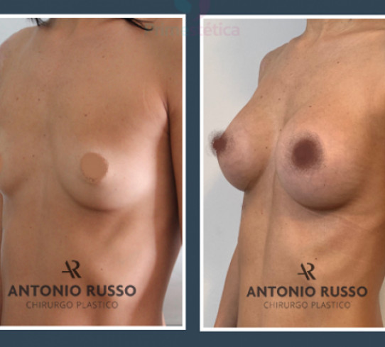 Mastoplastica additiva Dr Antonio Russo