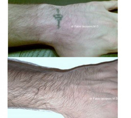 Rimozione tatuaggi Dott. Fabio Iacoponi