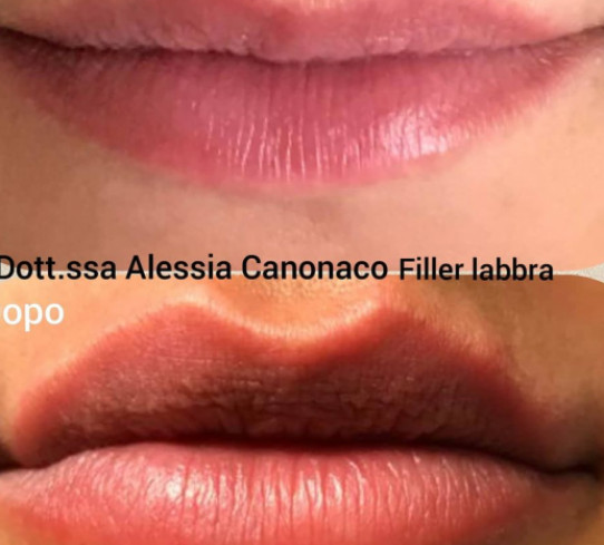 Filler Labbra Dott.ssa Alessia Canonaco